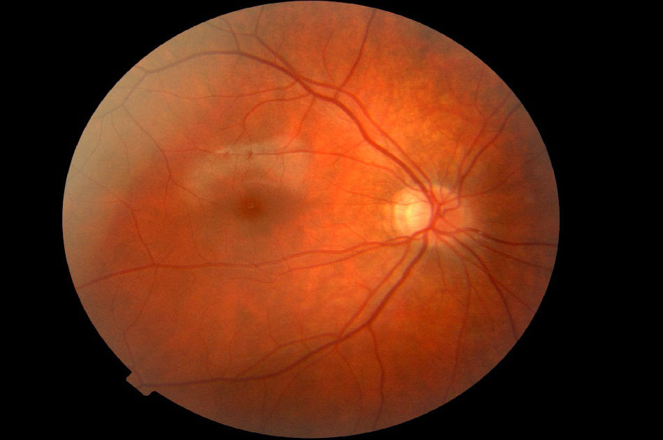 Ангиопатия сетчатки глаза, обоих глаз (диабетическая, гипертоническая, гипотоническая, травматическая, юношеская) – что это такое?