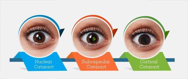 Почему катаракта так опасна и как от неё избавиться