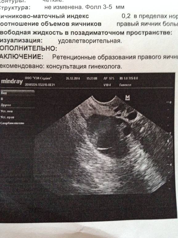 Анэхогенное образование в яичнике что это такое (жидкостные образования) | kvd9spb.ru