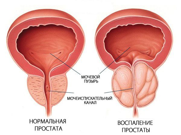 Функции предстательной железы у мужчин: зачем нужна простата и за что она отвечает