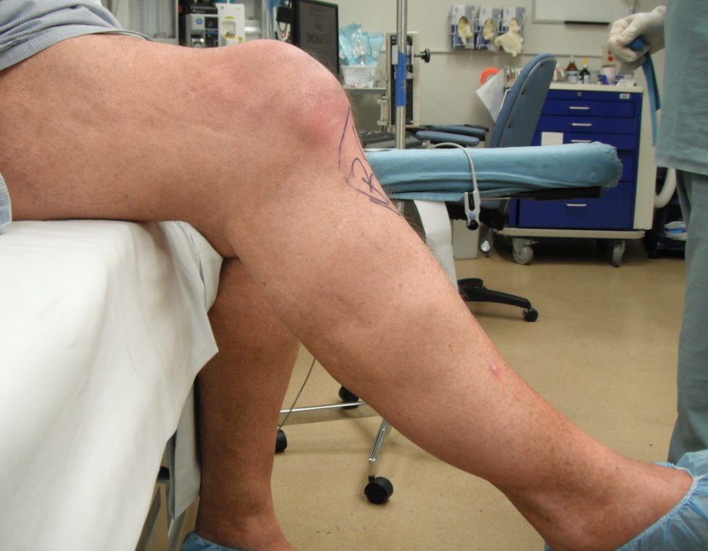 Cиновит коленного сустава : причины, симптомы, диагностика, лечение | компетентно о здоровье на ilive