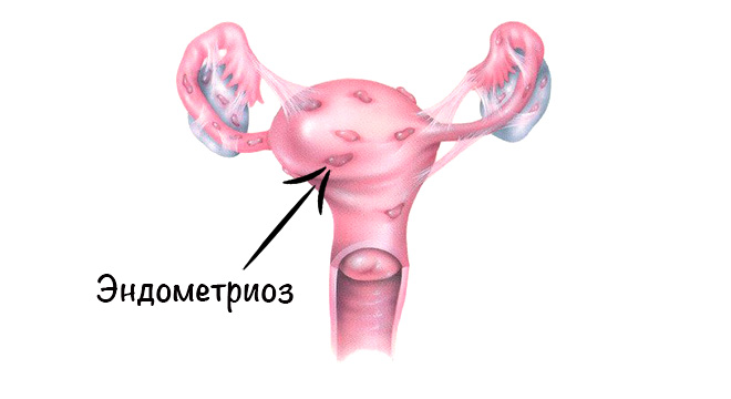 Основные отличия эндометриоза от гиперплазии эндометрия