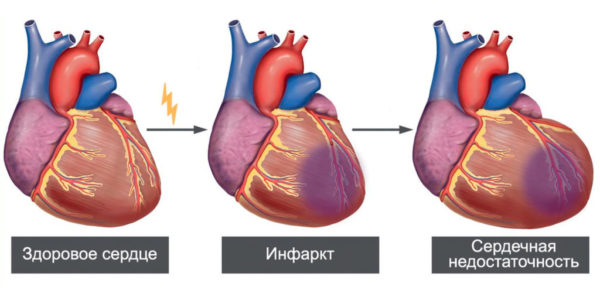 “инфаркт миокарда: первые признаки, как избежать тяжелых последствий?”