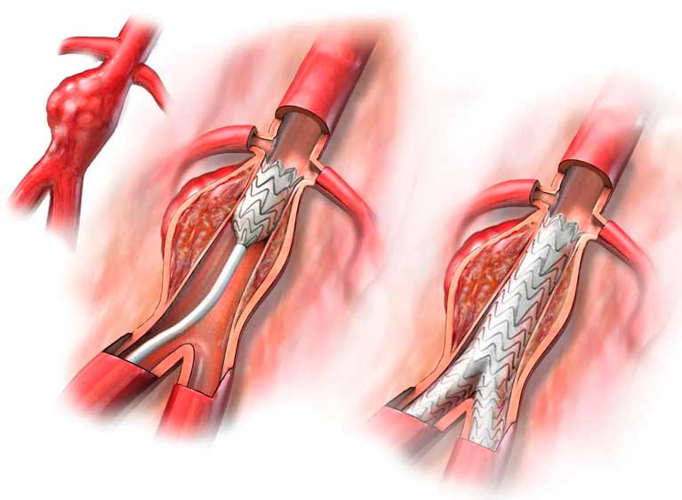 Коронарное шунтирование сосудов сердца: операция и её последствия