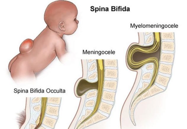 Спина бифида у детей: диагностика и хирургическое лечение