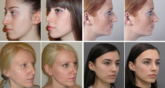 Ринопластика носа: виды, показания, цены и фото до и после
