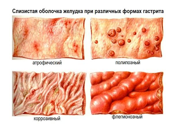 Гастрит: симптомы, диагностика и лечение