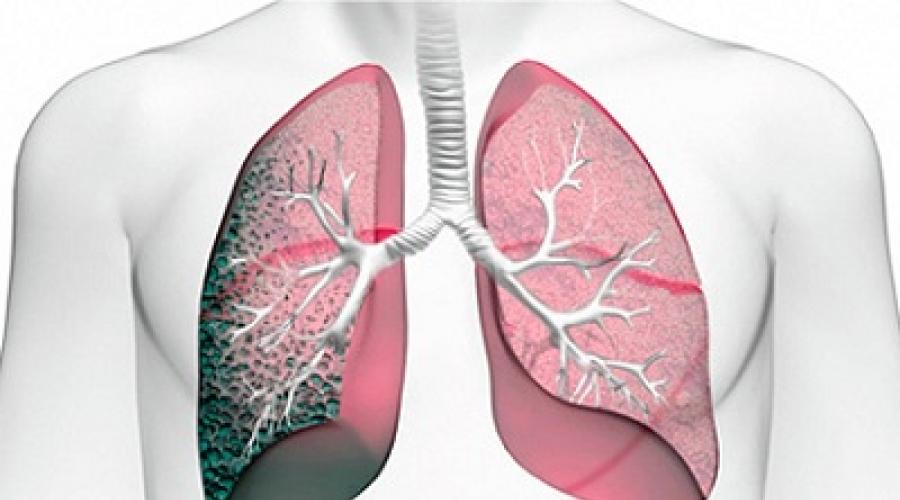 Прикорневой пневмосклероз легких: что это такое и как его лечить pulmono.ru
прикорневой пневмосклероз легких: что это такое и как его лечить