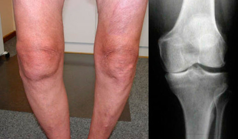Артроз коленного сустава: симптомы, причины и эффективное лечение