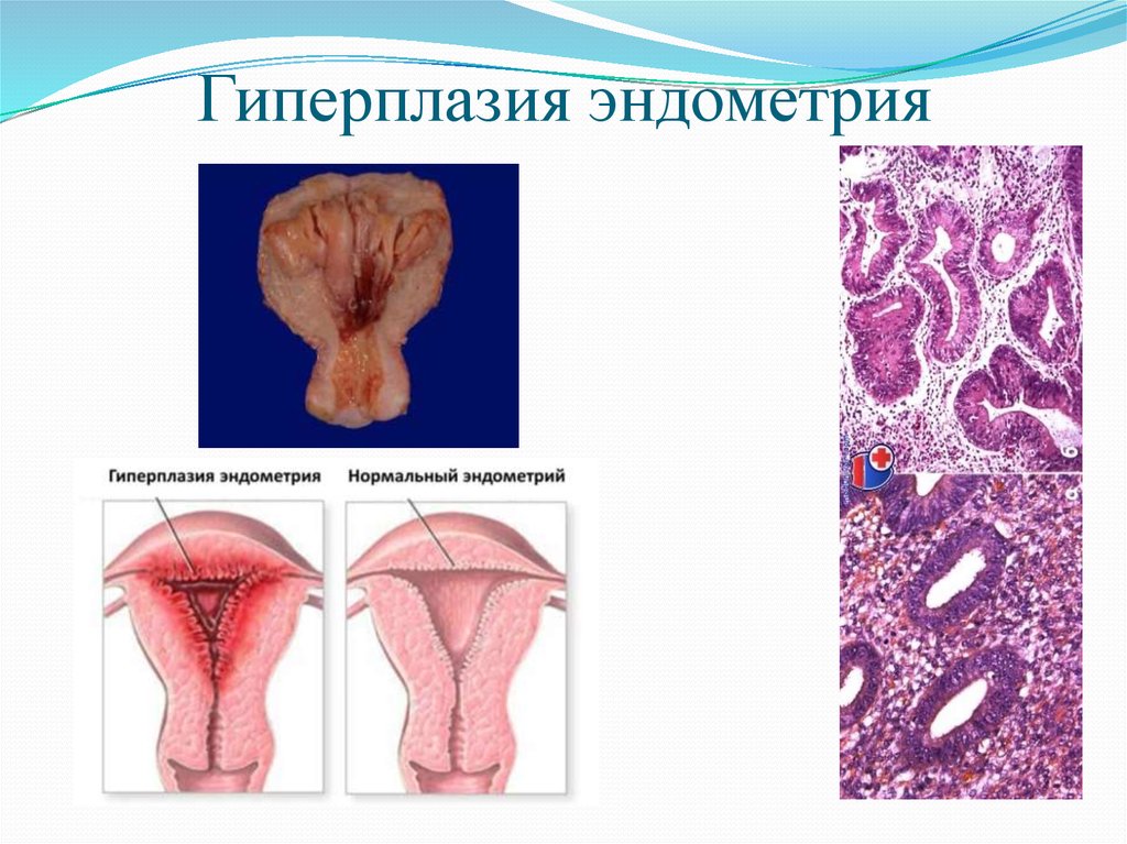 Миома и эндометрия гиперплазия