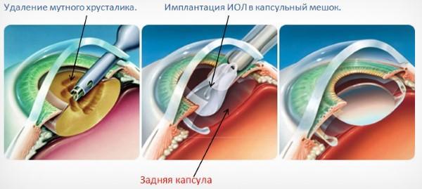 Почему катаракта так опасна и как от неё избавиться