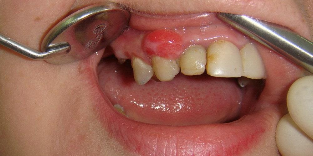 Зубной флюс - как быстро снять опухоль и отек на десне, какие средства помогают?
