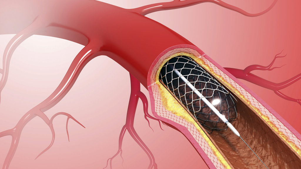 Коронарная ангиопластика и стентирование коронарных артерий