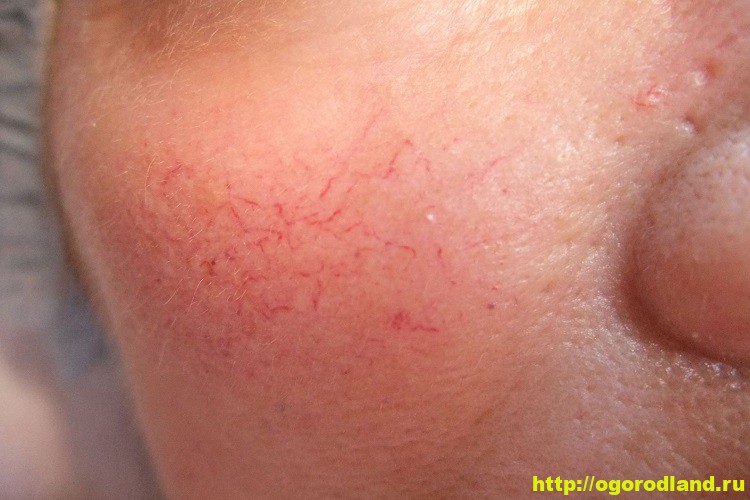Что такое купероз на лице – причины и лечение!