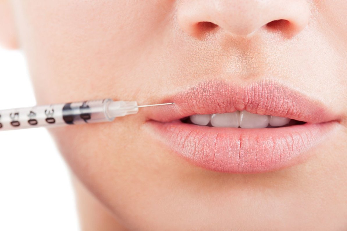 Аугментация губ: что необходимо знать, прежде чем сделать увеличение объема губ