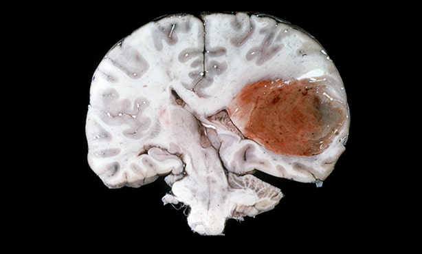 Глиобластома головного мозга: самая страшная опухоль