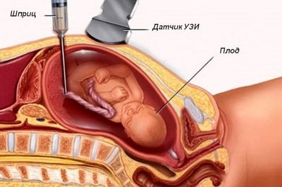 Оболочечное, краевое и боковое прикрепление пуповины: как рожают при оболочной и эксцентричной, центральной формах, последствия для ребенка