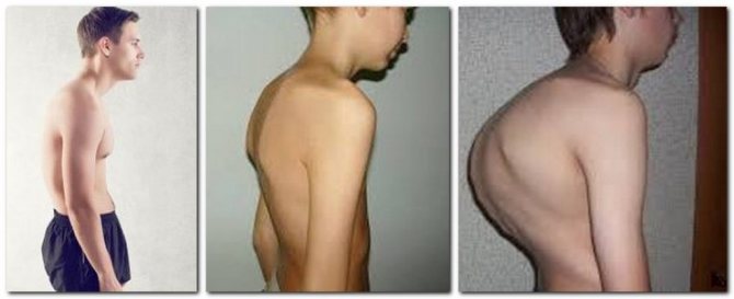 Кифоз грудного отдела позвоночника: симптомы и лечение