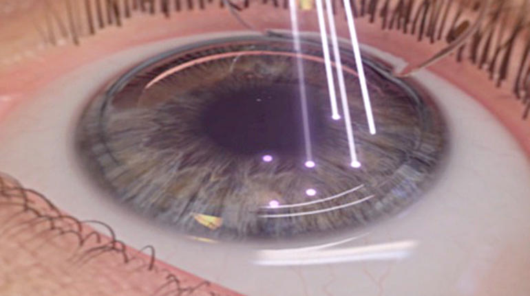 Пресбиопия глаз: что это такое и в каком возрасте развивается