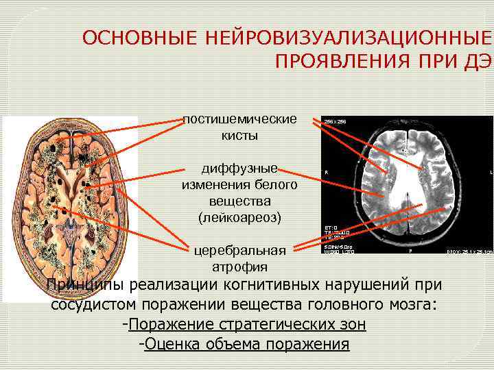 Что такое лейкоареоз головного мозга