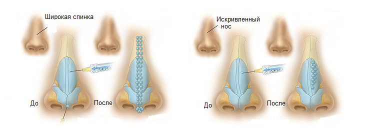 Ринопластика: за и против операции по коррекции формы носа
