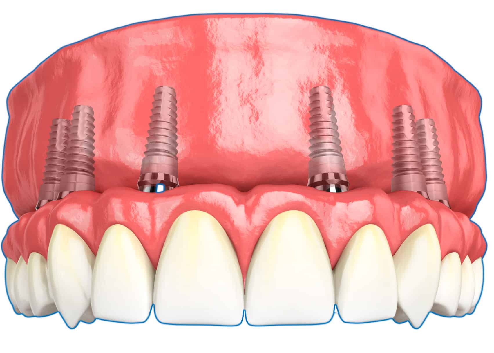 Скуловая имплантация зубов - что это, преимущества и особенности