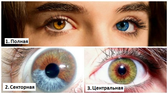 Гетерохромия глаз. почему может появляться разный цвет глаз у человека?
