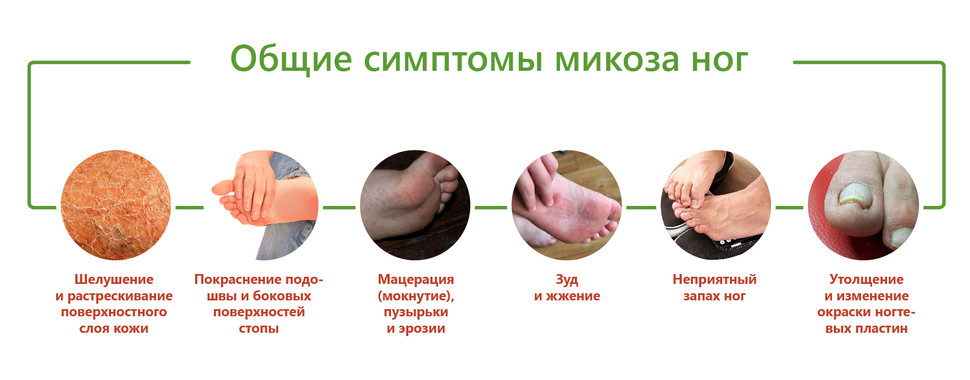 Как выглядит грибок на ногтях ног: подробные фото, эффективные средства лечения