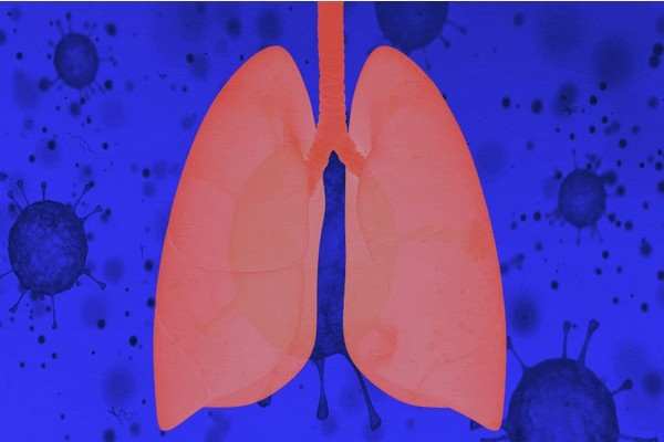 Пневмонит и воспаление лёгких (пневмонии) - основные отличия