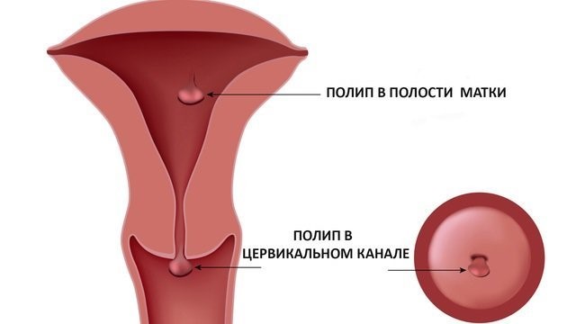 Аденоматозный полип эндометрия в матке - лечение, удаление