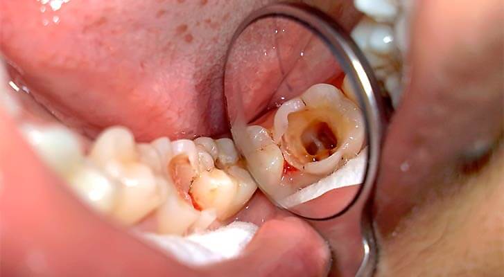 Лечение пульпита зуба: как избавиться от ужасной боли | новости