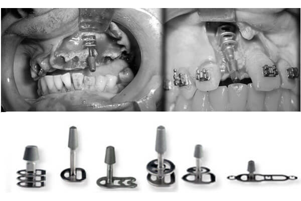 Базальная имплантация зубов: что такое, сколько стоит, сравнение и преимущества базальтовых имплантатов