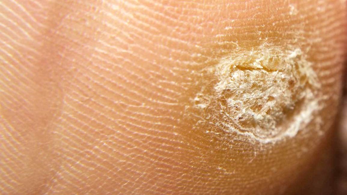 Что значит гиперкератоз? как убрать уплотнения на коже рук и ног?