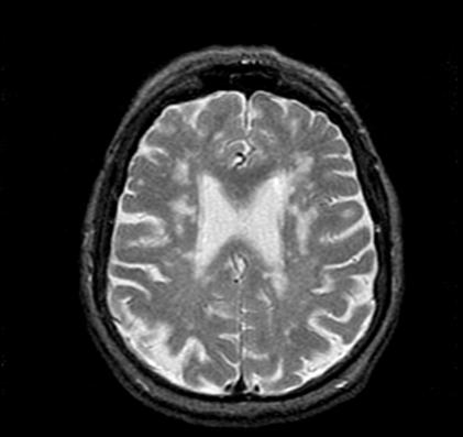Что это такое лейкоареоз головного мозга: симптомы, лечение, профилактика