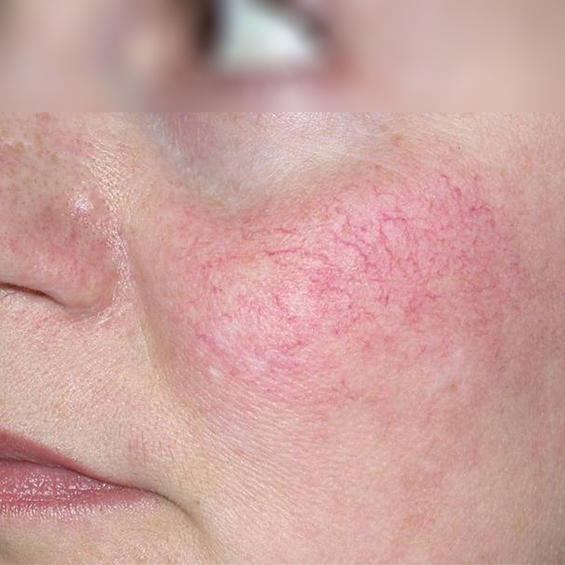 Что такое купероз на лице – причины и лечение!