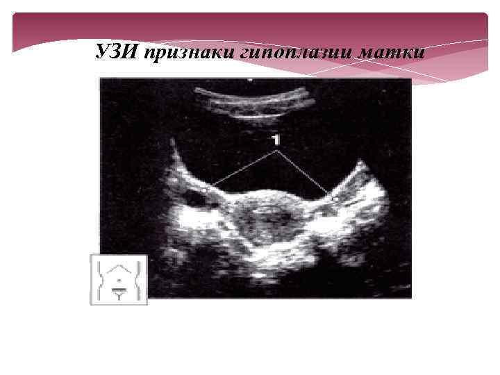 Гипоплазия матки и беременность: совместимы или нет?