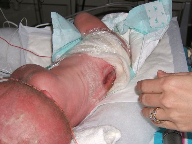 Спина бифида (spina bifida) - расщепление позвоночника: причины и последствия