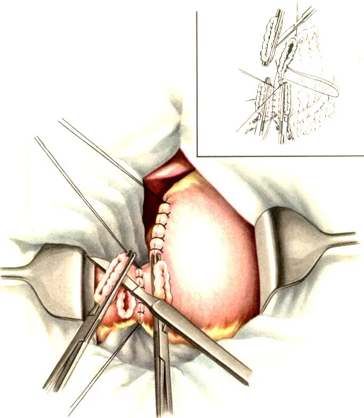 Резекция яичника: цель операции и что это такое, последствия хирургического вмешательства