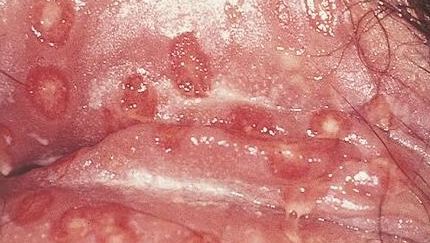 Красивые малые половые губы. фото до и после лабиопластики - центр эстетической медицины