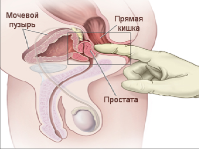 Полезен ли массаж простаты, техника выполнения