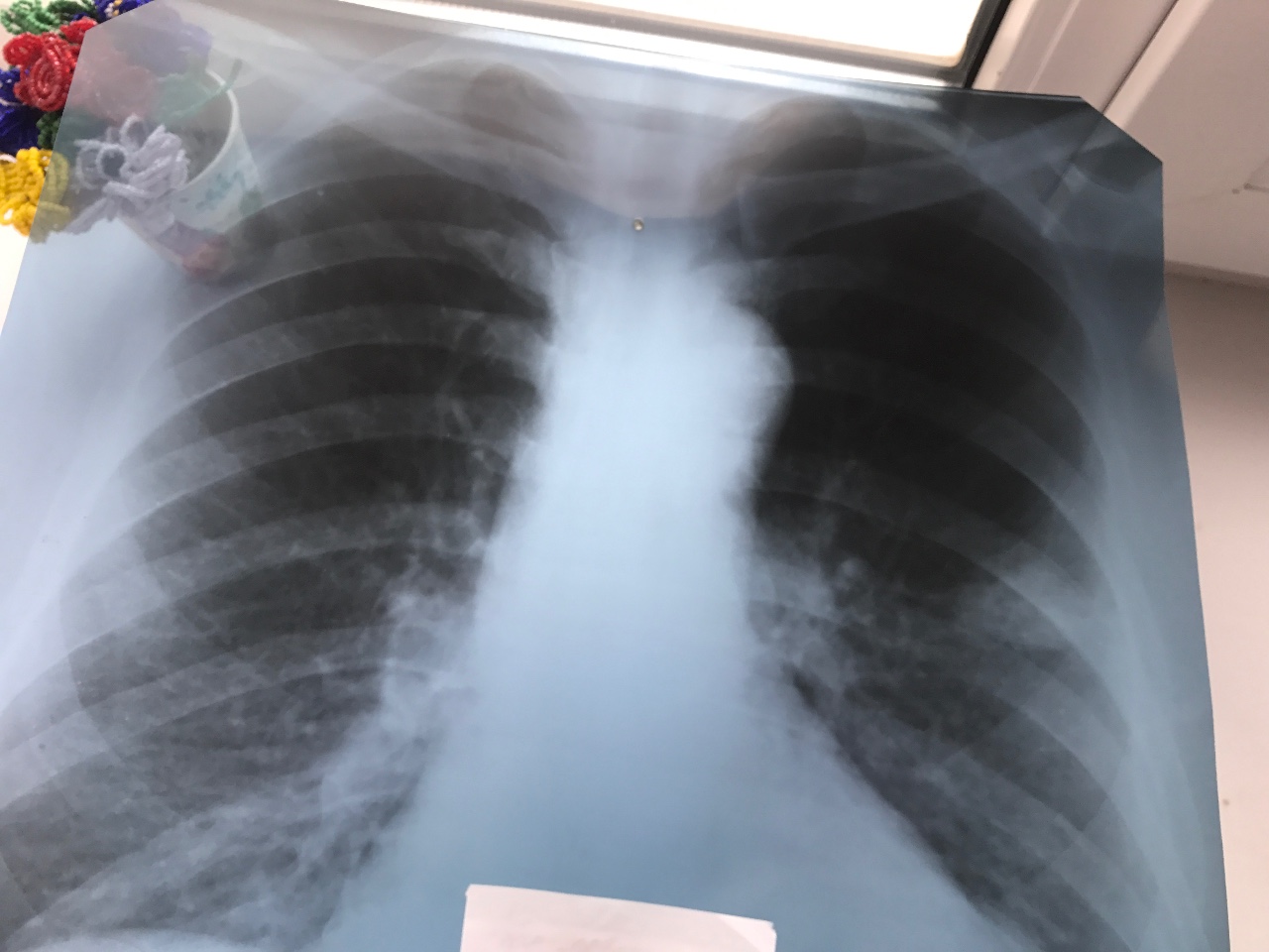 В чем разница между рентгеном и флюорографией легких | мед центр «гармония»
