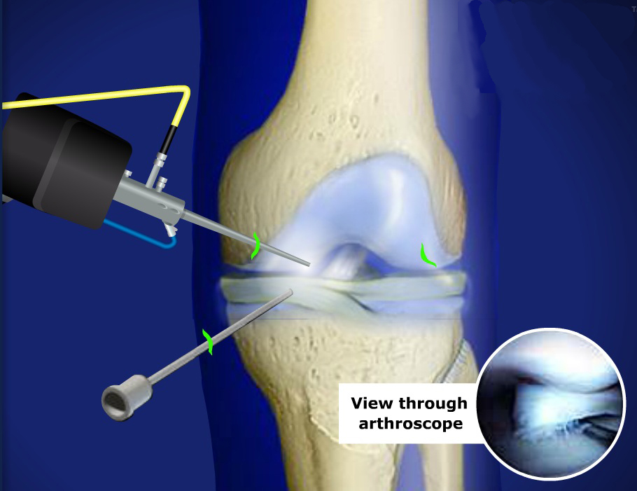 Мениск коленного сустава - лечение разрыва и симптомы повреждения, операция при травме и реабилитация