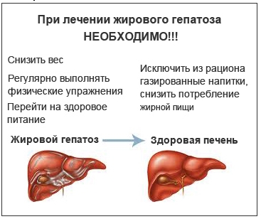 Жировой гепатоз печени: симптомы и лечение